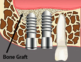 bone graft