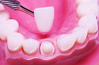 Cosmetic Dentistry - Porcelain crowns