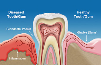 gum disease illistration