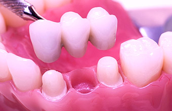 With a bridge, the patient's teeth must be ground down to support the restoration.