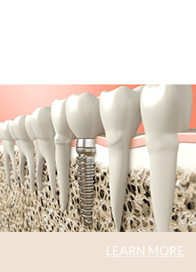 Complimentary Dental Implant Consultation